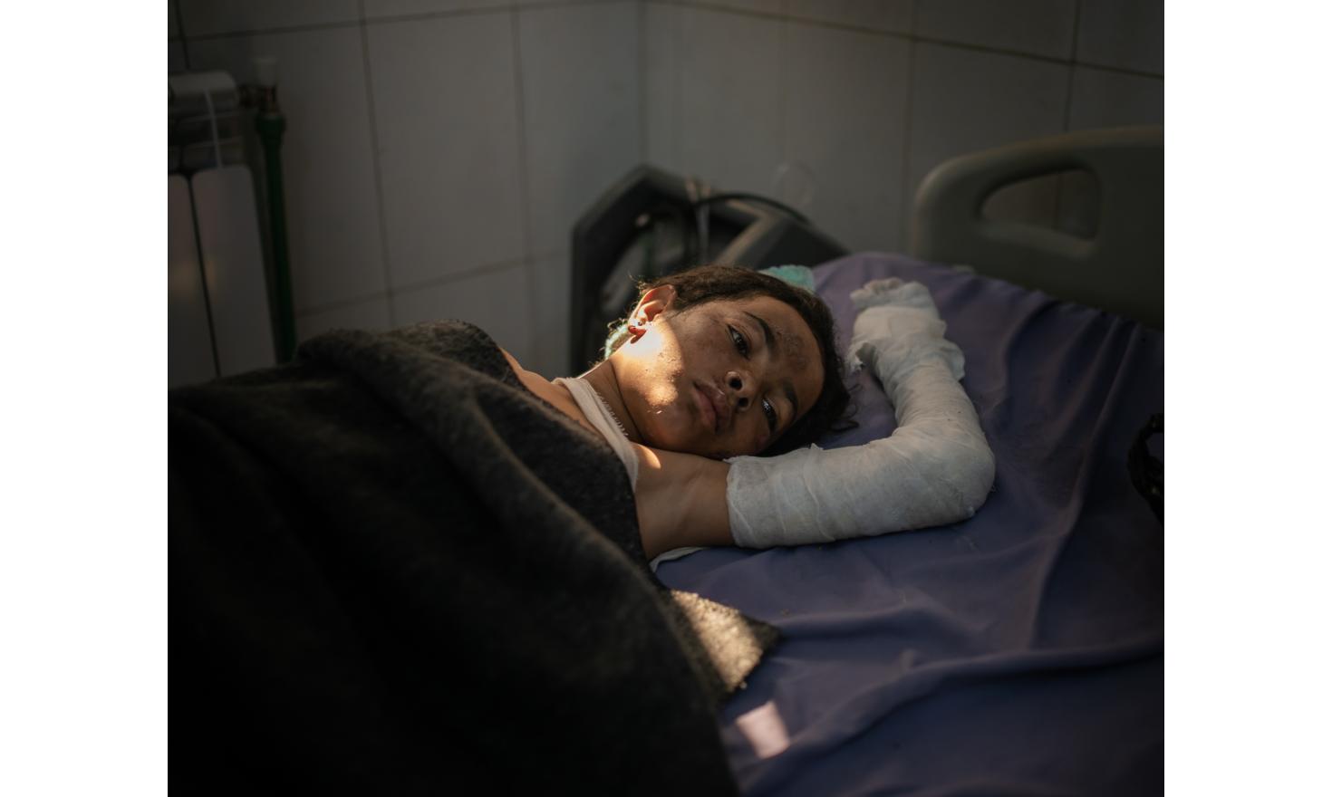 The lost children of the caliphate A young giurl from Al-Hawl camp in Hassakeh National Hospital. Fires are common in the camp due to the poor heating conditions.